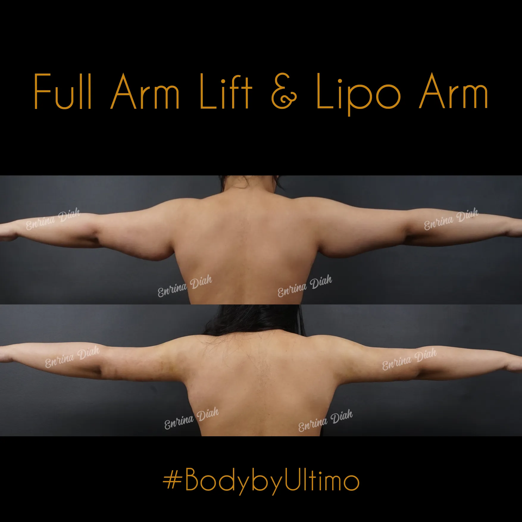 Adlina Ramly - Arm Lift - IG POST - 1 - CASE 6