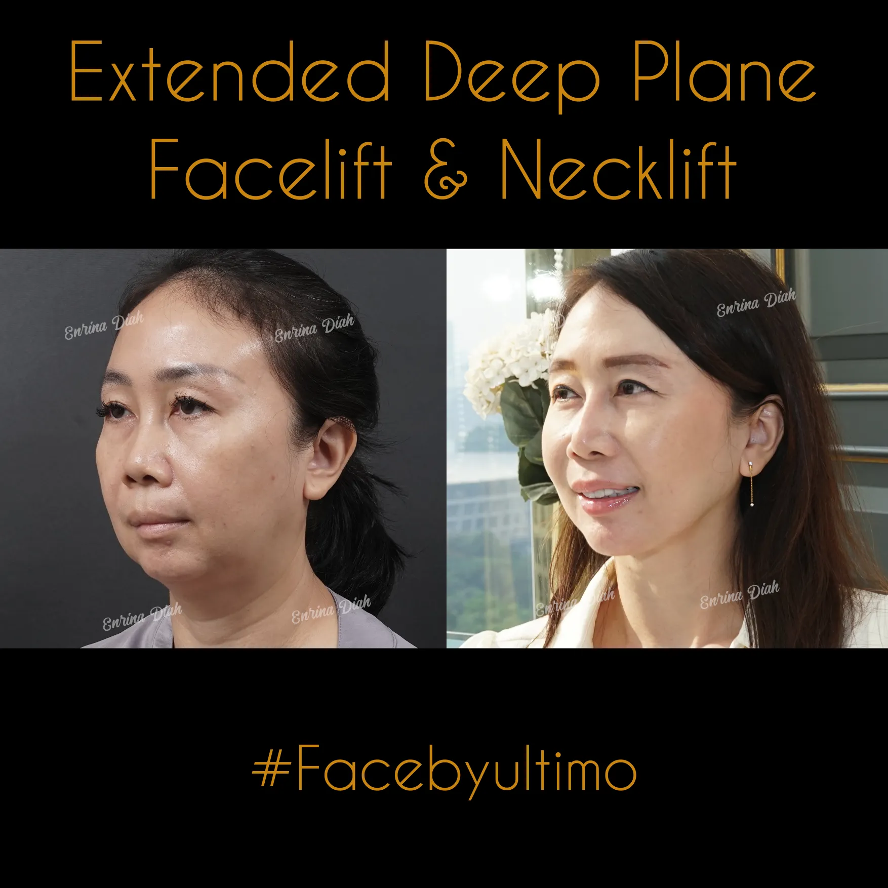 Anne Meling -post IG - FACELIFT - 2A - case 31