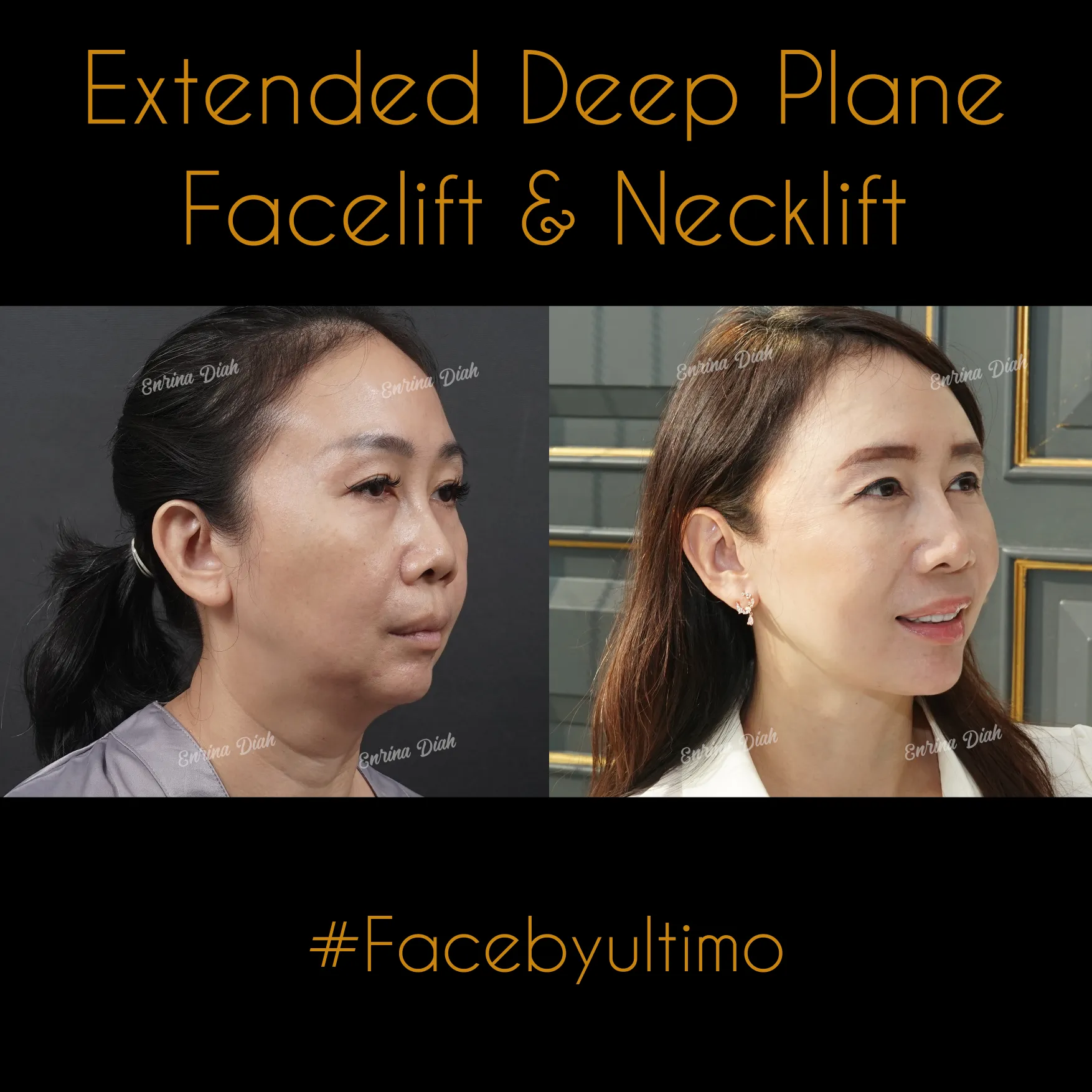 Anne Meling -post IG - FACELIFT - 2B - case 31