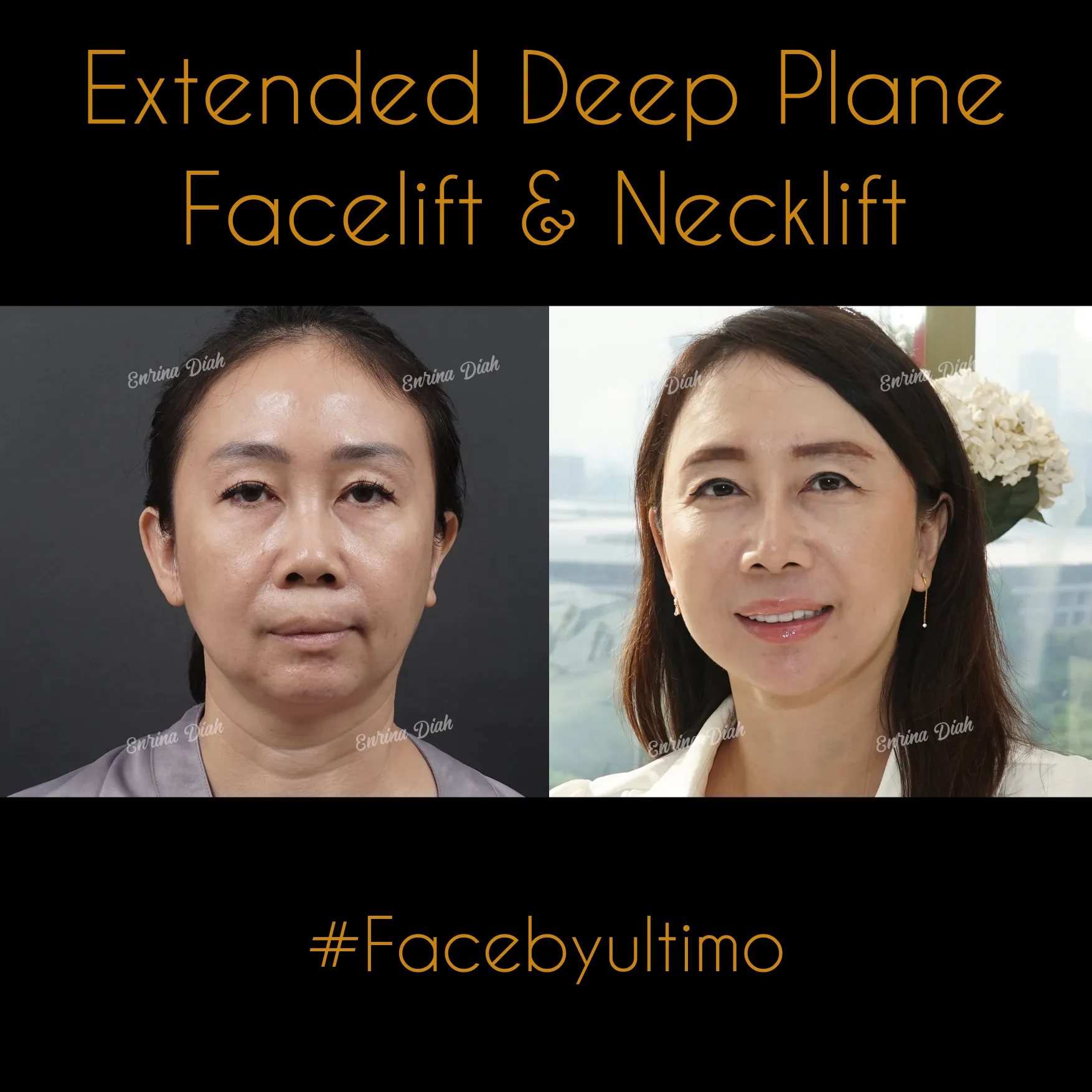 Anne Meling -post IG - FACELIFT - 2C - case 31