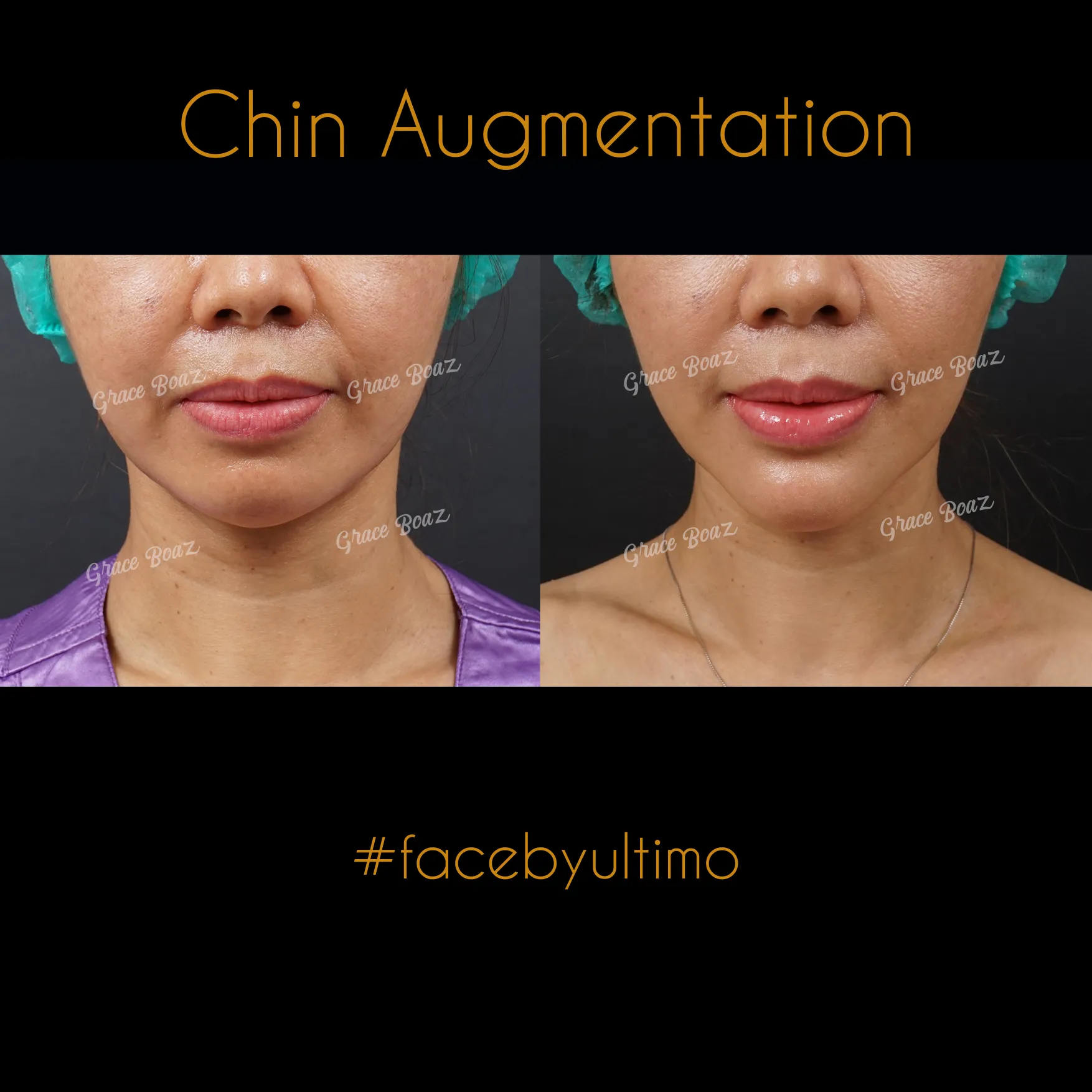 Arnenita Indry Alfianti -IG POST- - BEFORE AFTER CHIN AUG - 1 - case 35
