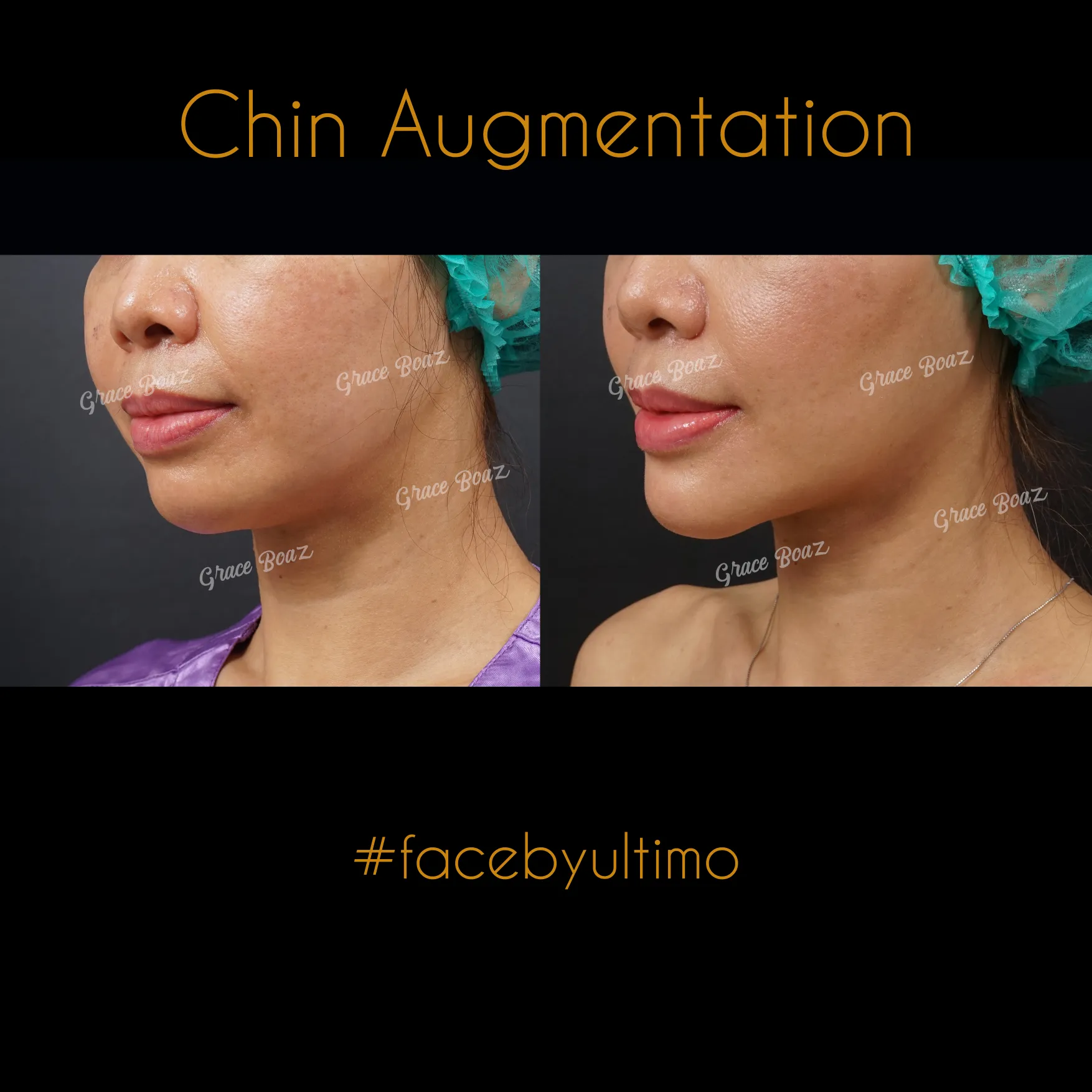 Arnenita Indry Alfianti -IG POST- - BEFORE AFTER CHIN AUG - 2 - case 35