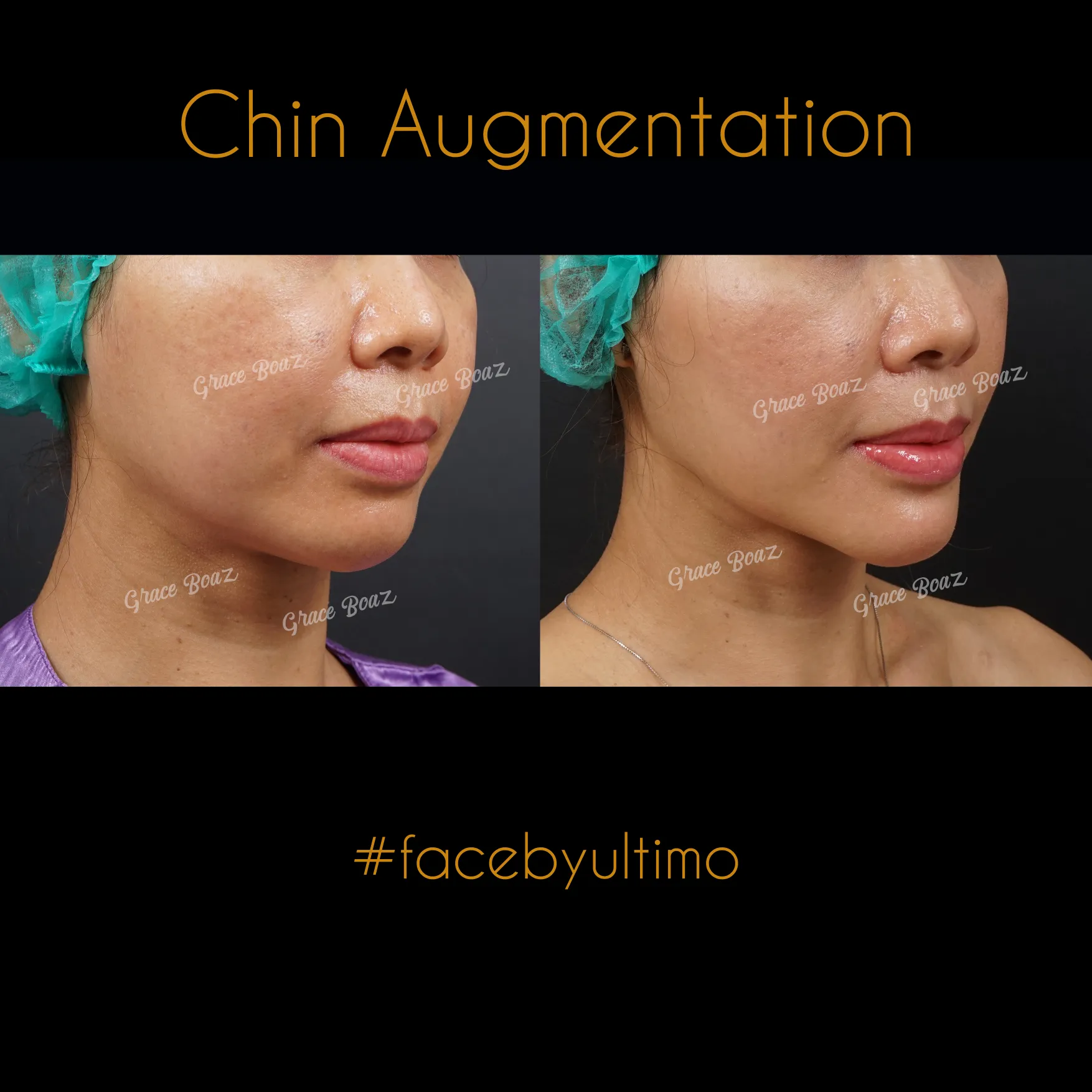 Arnenita Indry Alfianti -IG POST- - BEFORE AFTER CHIN AUG - 3 - case 35