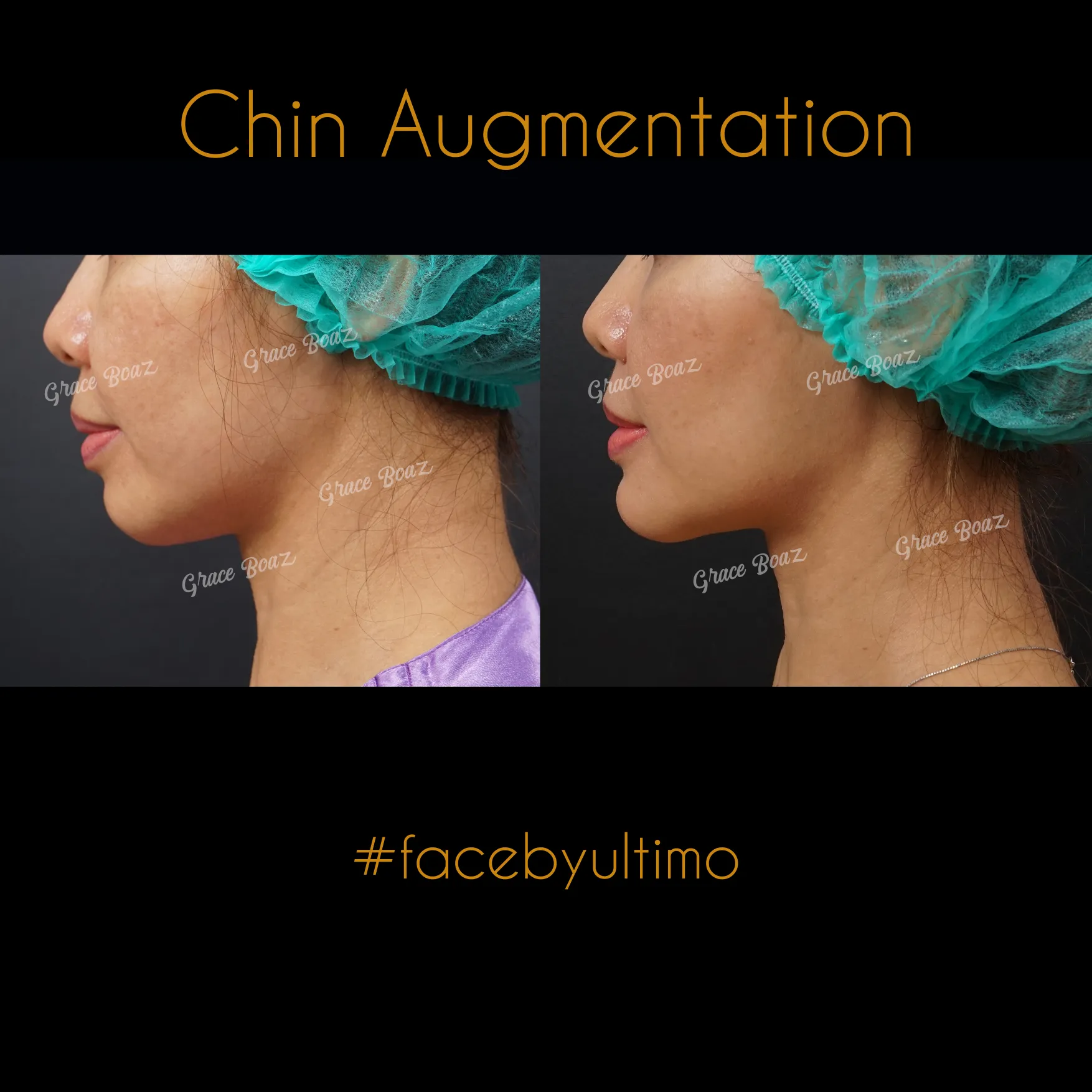 Arnenita Indry Alfianti -IG POST- - BEFORE AFTER CHIN AUG - 4 - case 35