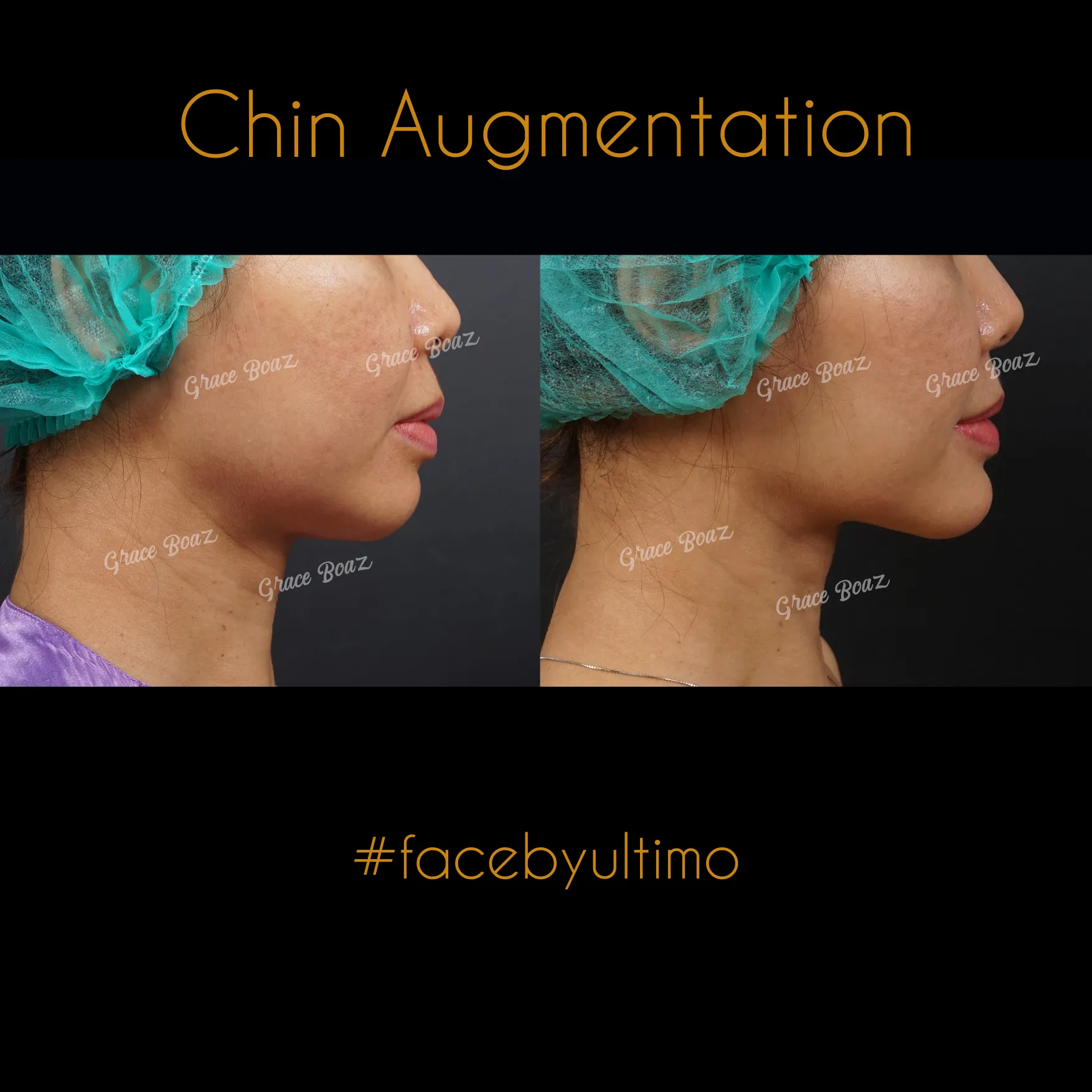 Arnenita Indry Alfianti -IG POST- - BEFORE AFTER CHIN AUG - 5 - case 35