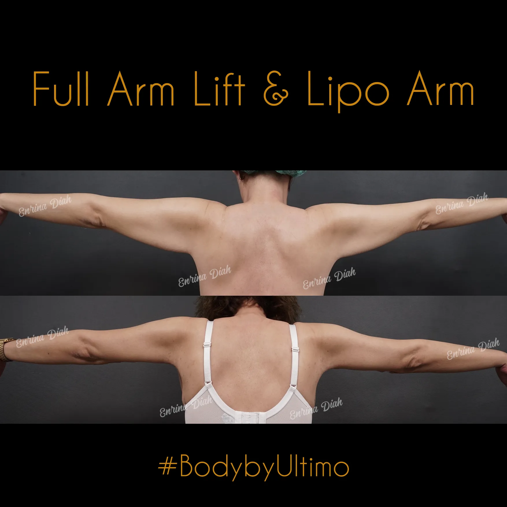 Hsin Cheeh - Puh - Arm Lift - IG POST - 1 - CASE 7