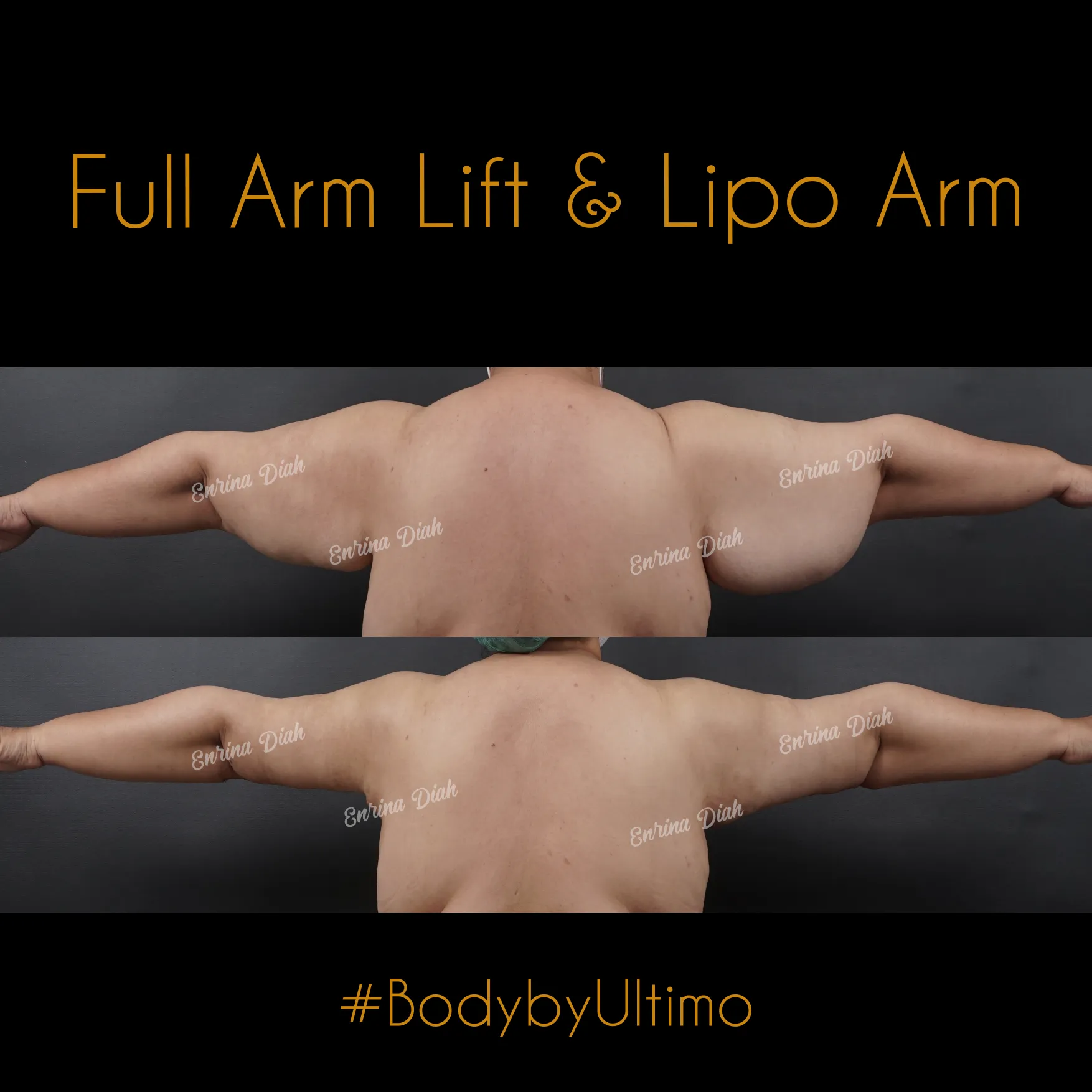 Sri Eka - Arm Lift - IG POST - 2 - CASE 8