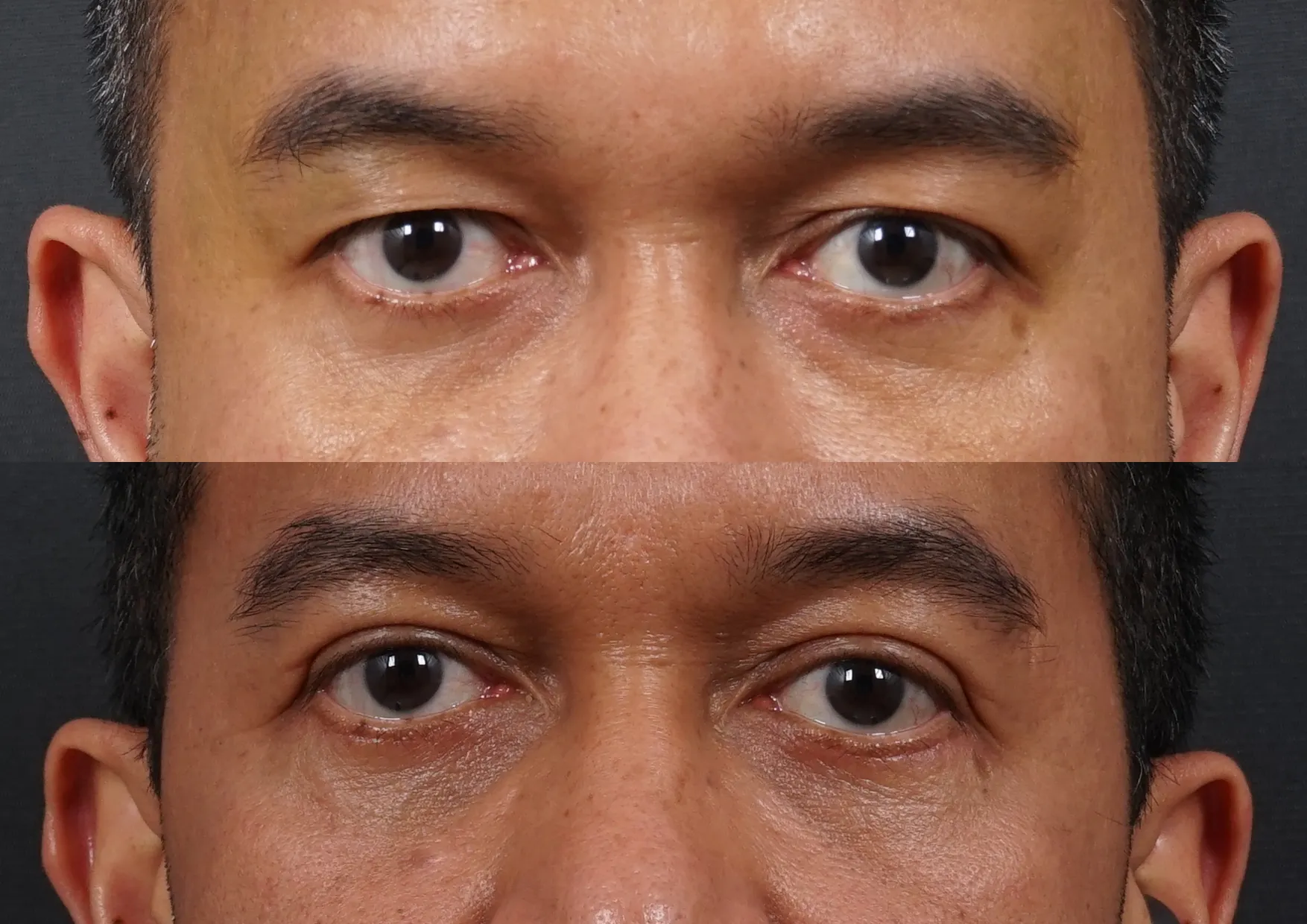 blepharo dr david - case 18